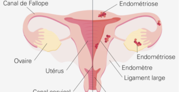 Un test salivaire pour diagnostiquer l’endométriose