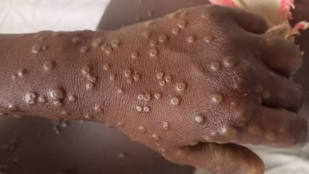 Mpox