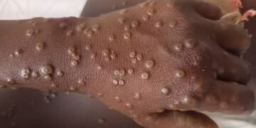 Mpox