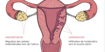 Endométriose : la maladie silencieuse qui frappe une femme sur dix, de Paris à Lagos
